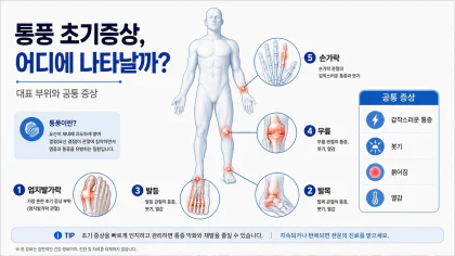 통풍 초기증상이 자주 나타나는 엄지발가락, 발목, 발등, 무릎, 손가락 위치를 설명한 특성 이미지