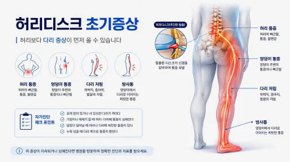 허리디스크 초기증상과 허리에서 다리로 이어지는 신경 통증을 설명한 그림 특성 이미지